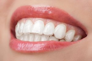Why Should You Use Clear Retainers?