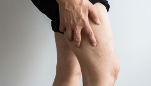Myths and Misconceptions of Varicose Veins