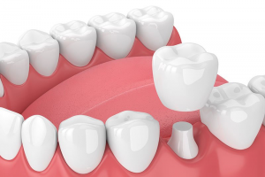 5 Common Reasons To Consider Crowns
