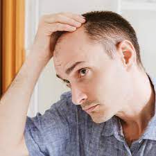 High Testosterone and Hair loss: Relation & Everything Else